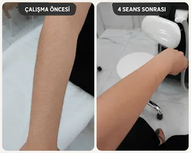 Lazer epilasyon öncesi ve 4 seans sonrası gerçek sonuç — Sensei Privé Şanlıurfa